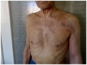 Тромбоз подключичной вены