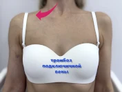 Синдром Педжета-Шреттера