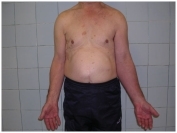 Тромбоз внутренней яремной и подключичной вены