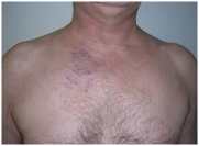 Тромбоз подключичной вены