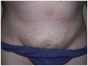 Посттромбофлебитическая болезнь