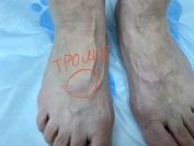 Тромбофлебит вен стопы