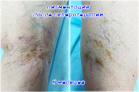 Пигментация после склеротерапии