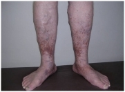 Варикозная болезнь