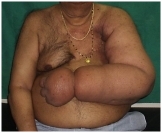 Лимфостаз на руке