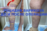 Рецидивный варикоз и неоангиогенез