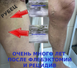 Рецидивный варикоз