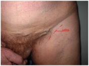 Рецидивный варикоз