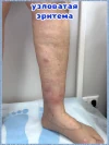 узловатая эритема