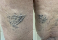 Судьба сосудистой сетки