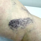 Ретикулярный варикоз тоже бывает опасным