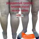 Рецидивный тромбоз глубоких вен