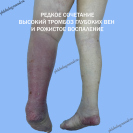 Тромбоз глубоких вен и рожистое воспаление