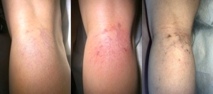 Микросклеротерапия без обмана.