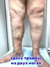 тромб на двух ногах