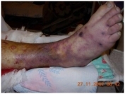 Синяя флегмазия