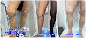 До и после лазерной операции