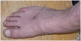 Поверхностный тромбофлебит