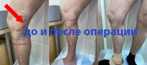 До и после операции по поводу варикозной болезни и сопутствующем тромбофлебите в стадии стихшего обострения