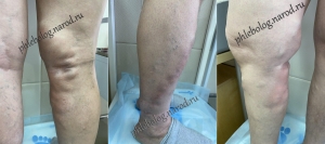 Тромбоз глубоких и поверхностных вен