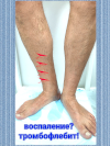 Тромбофлебит поверхностных вен
