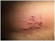 Телеангиэктазии