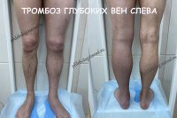 Тромбоз глубоких вен - илеофеморальный тромбоз.