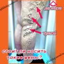 Тромбофлебит поверхностный