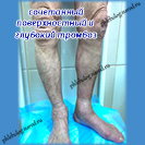 Тромбоз глубоких и поверхностных вен