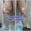 тромбофлебит поверхностных вен