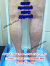 Тромбоз глубоких вен