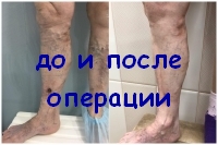 Операция помогла при трофической язве