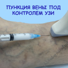 Склеротерапия под контролем УЗИ