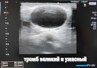 УЗИ картина тромбоза варикса поверхностной вены