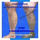 Результат лазерной коагуляции вен