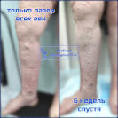 Тотальная ЭВЛК