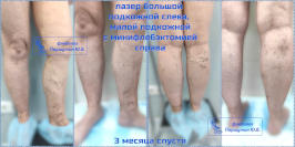 Лазер и минифлебэктомия