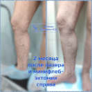 Лазер и минифлебэктомия