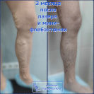 Лазер и минифлебэктомия