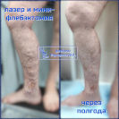 Лазер и минифлебэктомия