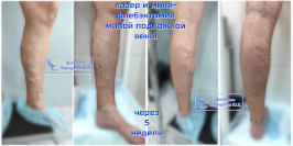 Лазер и минифлебэктомия