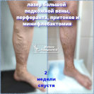 Лазер и минифлебэктомия