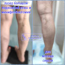 Лазер и минифлебэктомия