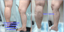 Тотальная ЭВЛК