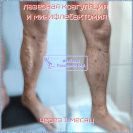 Лазерная коагуляция и минифлебэктомия