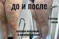Результат минифлебэктомии и лазерной коагуляции вен