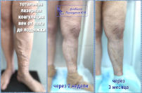 Только лазерная коагуляция всех видимых вен