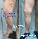 Лазер и минифлебэктомия