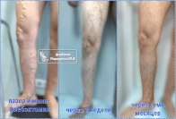 Лазер и минифлебэктомия