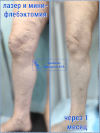 Лазер и минифлебэктомия
